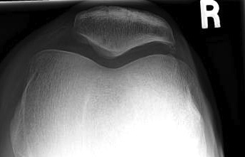 Patella Excessive Lateral Pressure